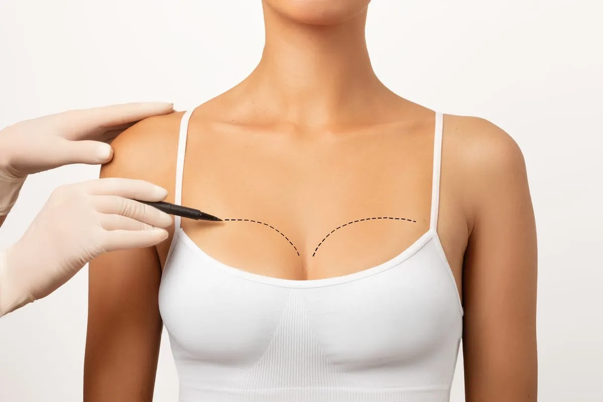 Surgical planning marks drawn on the upper chest before breast surgery