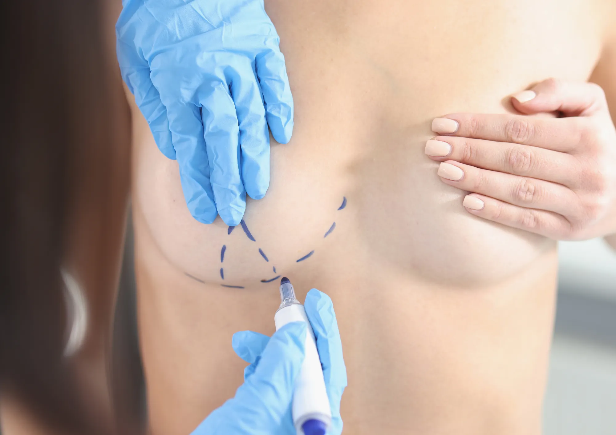 Illustration used for the breast reduction topic
