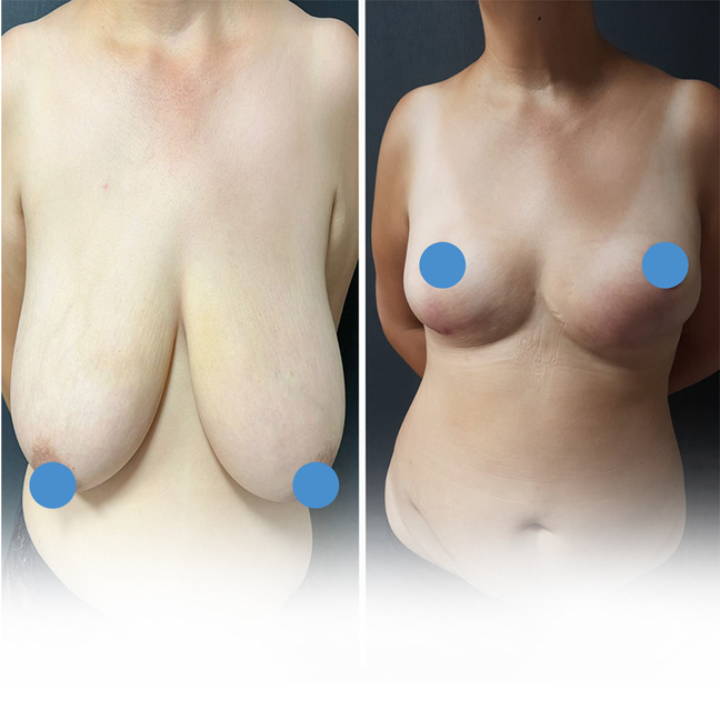 breast reduction before and after image