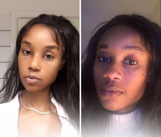 ethnic rhinoplasty before and after image