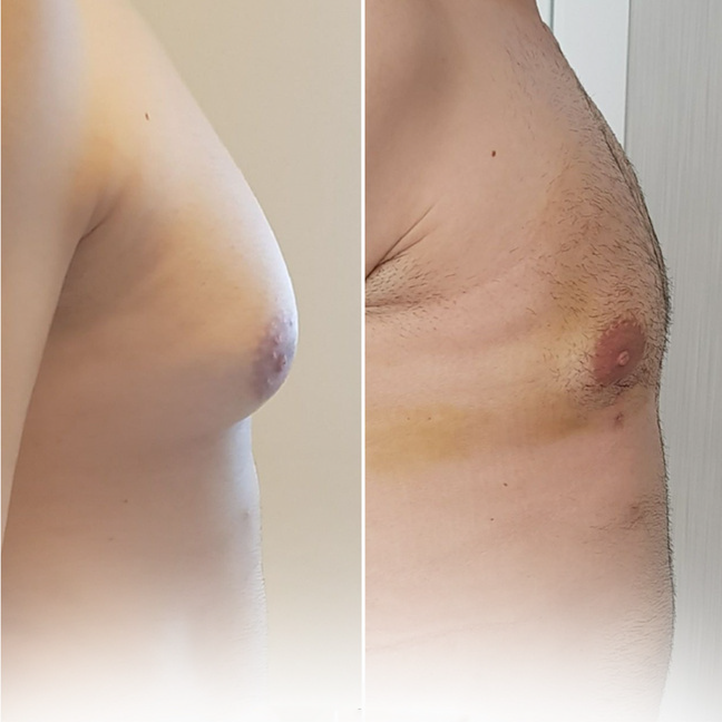 gynecomastia before and after image