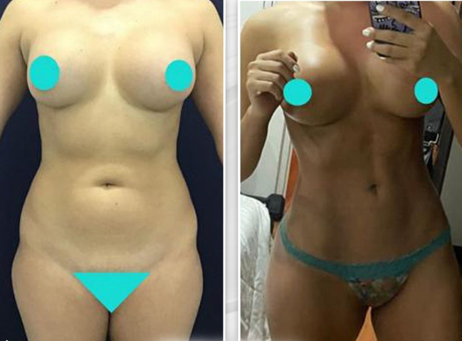liposuction 2 before and after image