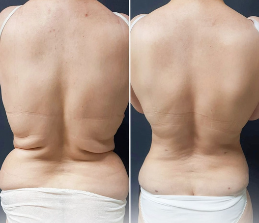 liposuction before and after image