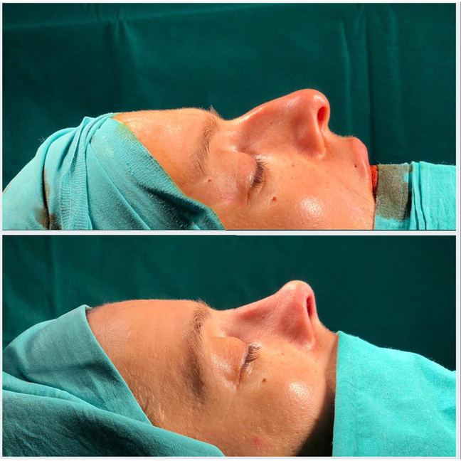 rhinoplasty before and after image