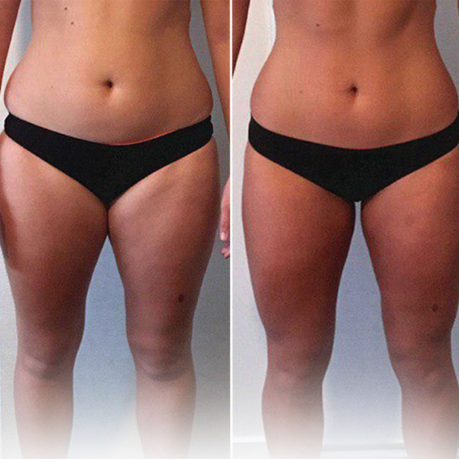thighlift before and after image