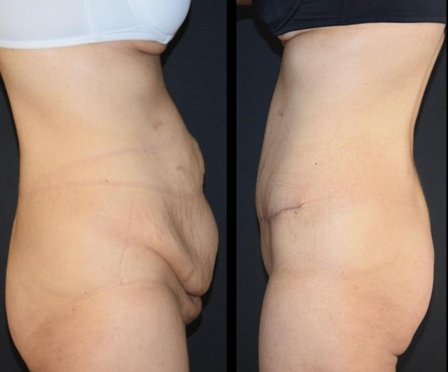 tummy tuck 2 before and after image