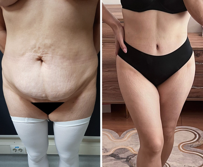 tummy tuck before and after image